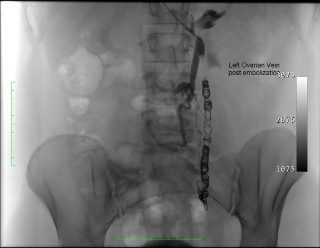 Ovarian Vein Embolisation Specialist Endovascular Services